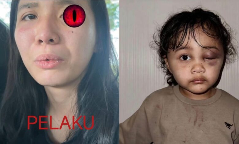 Anak Selegram Asal Malang Emy Aghnia, Diduga Dianiaya Suster