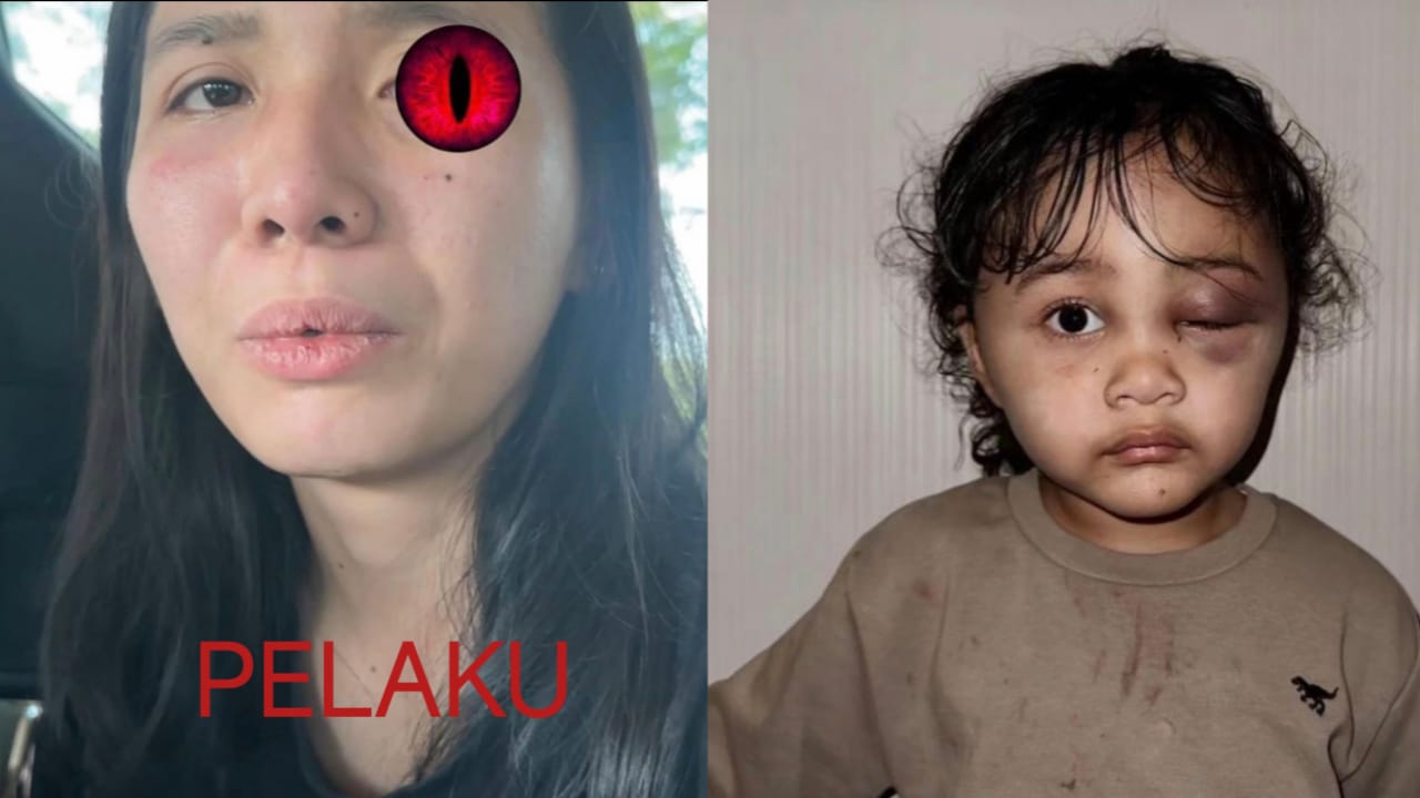 Anak Selegram Asal Malang Emy Aghnia, Diduga Dianiaya Suster